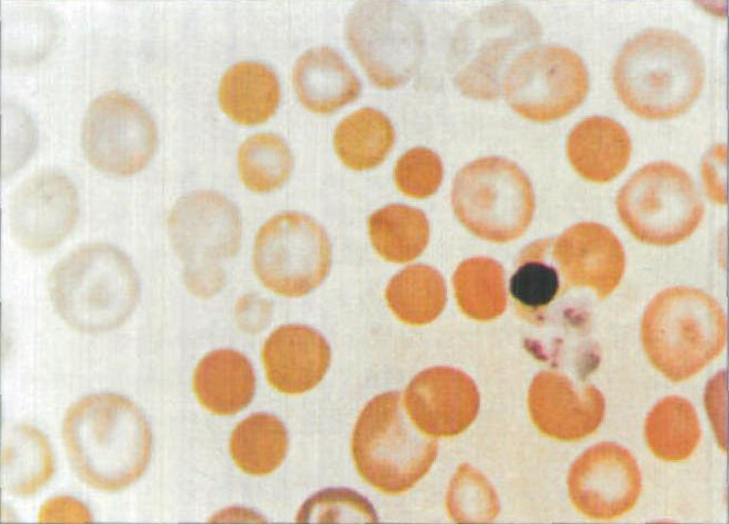 图4-15 自身免疫性溶血性贫血血像